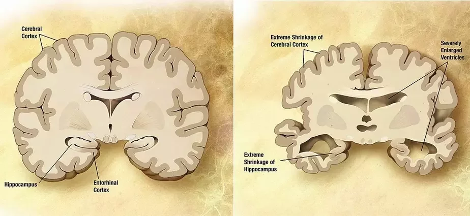 Мозг пажылога чалавека ў норме (злева) і пры паталогіі, выкліканай хваробай Альцгеймера (справа). Фота з Вікіпедыі.