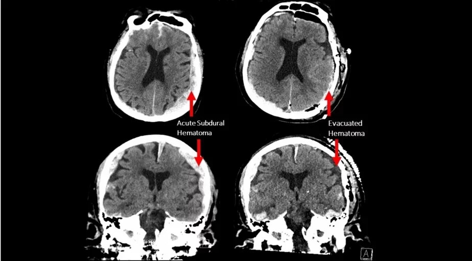 Компьютерная томография мозга пациента с травмой от неудачного падения. Изображение авторов исследования.
